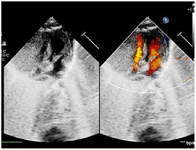 Surgical treatment of giant right ventricular fibroma for a newborn: A case report